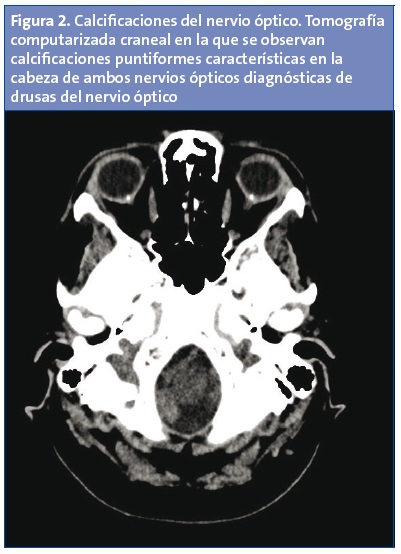 Figura 2. Calcificaciones del nervio óptico. Tomografía computarizada craneal en la que se observan calcificaciones puntiformes características en la cabeza de ambos nervios ópticos diagnósticas de drusas del nervio óptico.