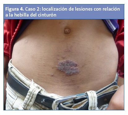 Dermatitis abdominal niño mactzul