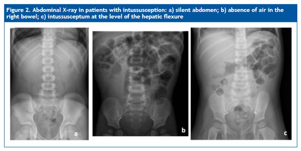 ¿Es posible el manejo ambulatorio de la invaginación intestinal?