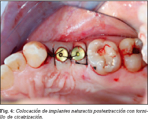 tabaco Discrepancia Stevenson Estudio clínico de los implantes dentales Naturactis en postextracción  dental