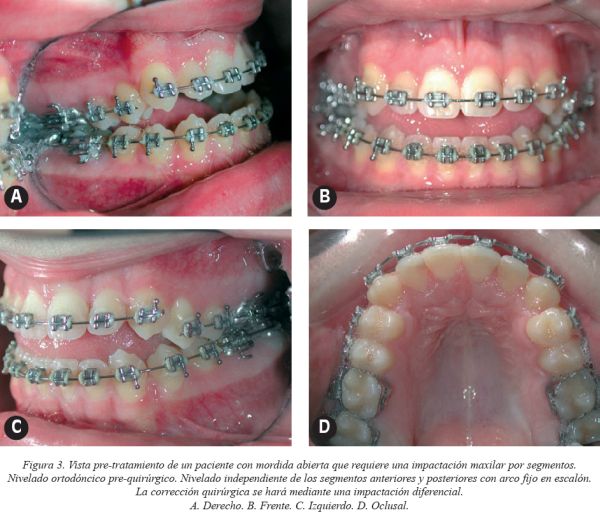 Los arcos dentales y su utilidad en ortodoncia con brackets