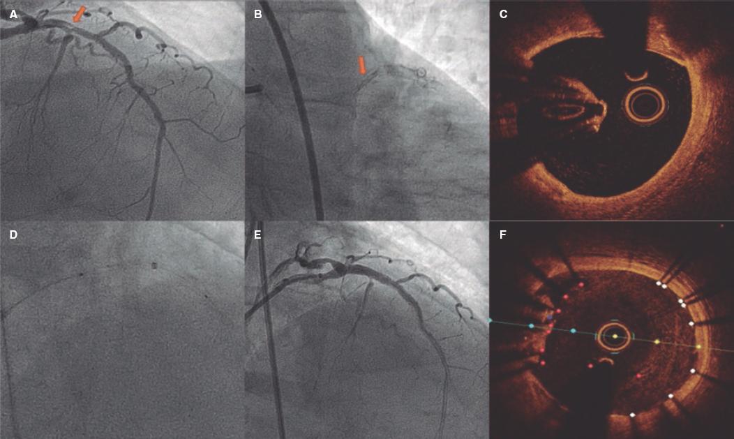Stent Rima The forgotten stent