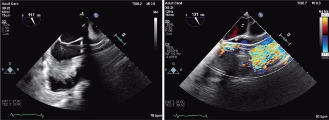 Impella-Clip: a secure and effective strategy in cardiogenic shock due ...