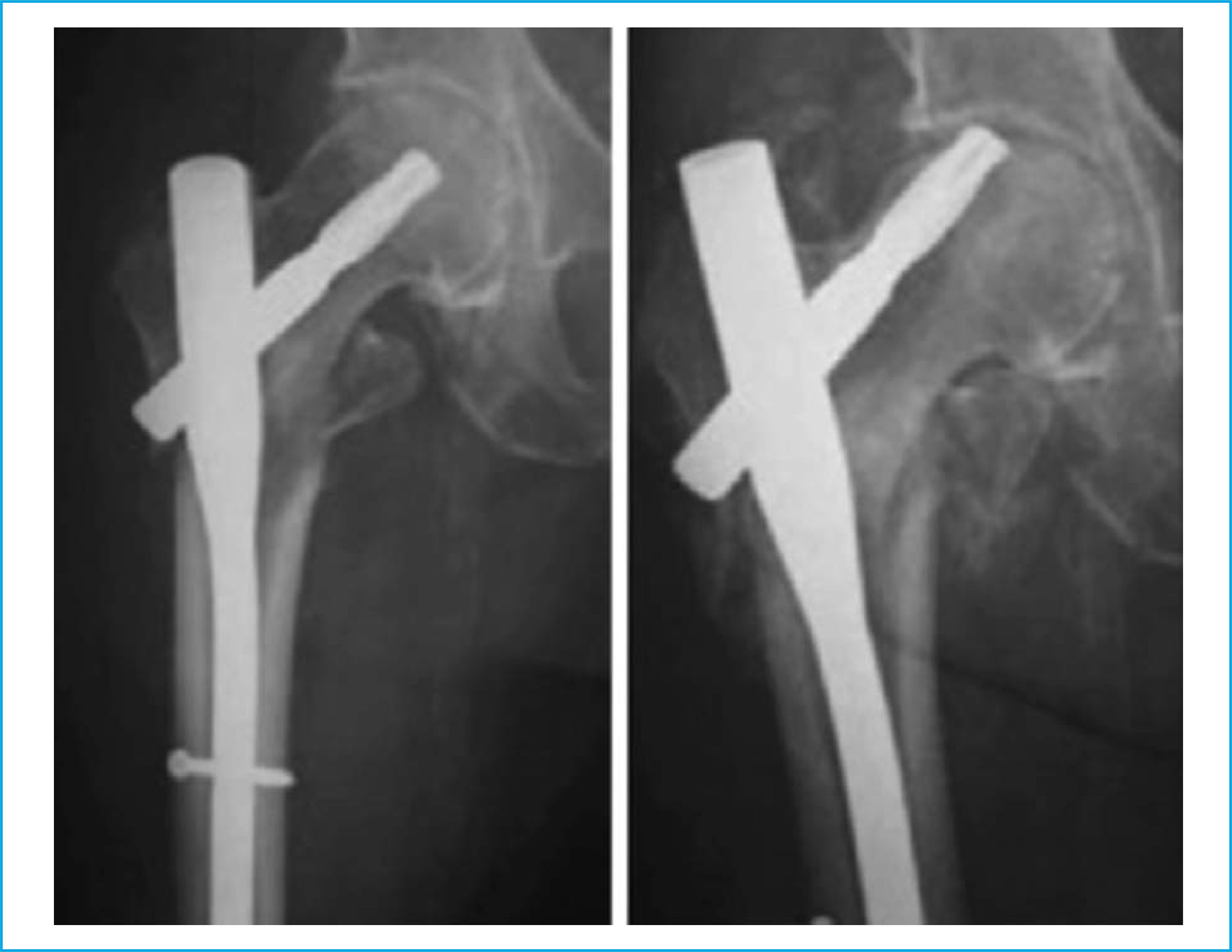 Intramedullary Nail For Intertrochanteric Hip Fracture - My Bios