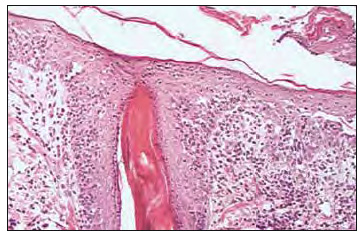 Figura 2. Separación de los estratos epiteliales intermedios. Abundante infiltrado inflamatorio. H-E. 100x.