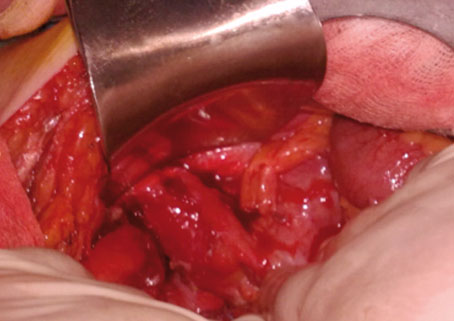 Figura 2. Apéndice vermiforme gangrenoso, largo, introduciéndose en el conducto inguinal derecho.