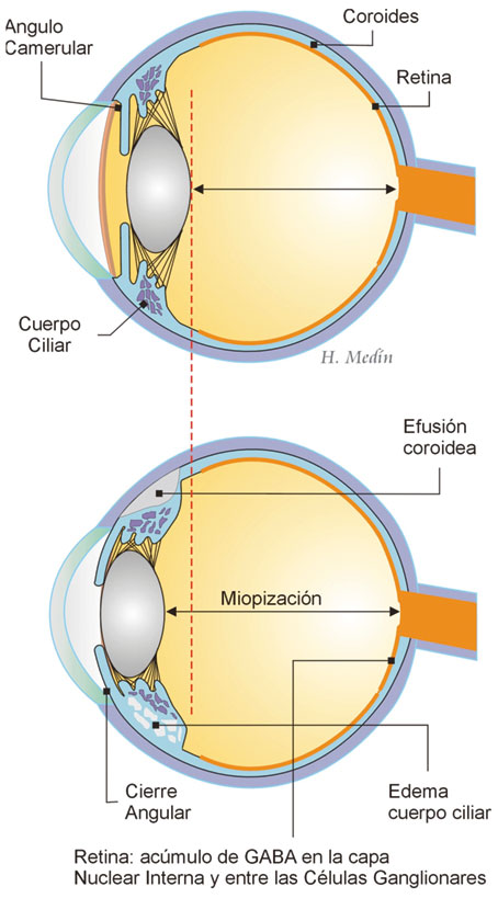 Figura 4. Principales efectos secundarios del topiramato a nivel ocular (Medín H.)