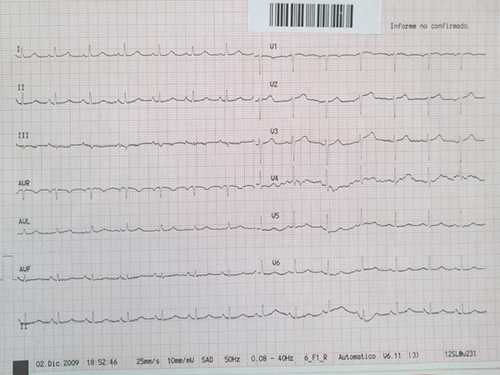 Figura 1. Electrocardiograma realizado a la llegada de la paciente al Servicio de Urgencias