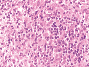 Figura 2.Se aprecia infiltrado de células linfocitarias en la masa tumoral. En el centro de la preparación se observa un núcleo de forma arriñonada. H-E.200x.
