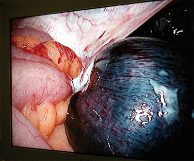 Imagen intraoperatoria del monitor de la cámara laparoscópica. Se aprecia La trompa de Falopio derecha estrangulando un asa de ileon y provocando necrosis isquémica.