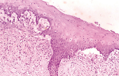 Lesiones recientes en las que se aprecia la formación de vacuolas a lo largo de la membrana basal. Moderado infiltrado inflamatorio. H-E 100x