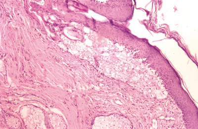 La epidermis está claramente separada de la dermis subyacente formando una bulla o vesícula. Las células basales permanecen intactas. H-E. 100x