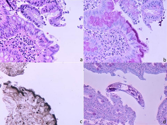 Human intestinal spirochetosis, histological finding associated with ...