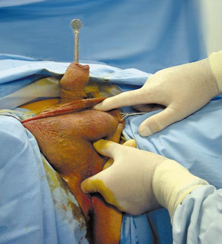 operacion cancer de prostata por laparoscopia