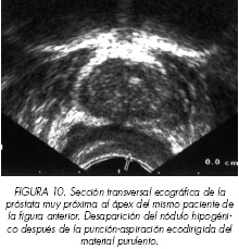 Papilloma vescicale benigno sintomi, Oxilați de prostatită
